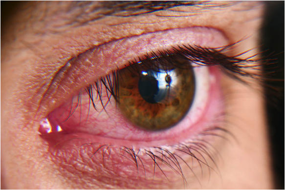 Red eye? Could it be a sign of Coronavirus?